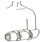 前腕部を固定した図